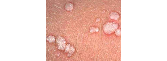 Genital Siğiller