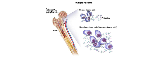 Multiple Myeloma